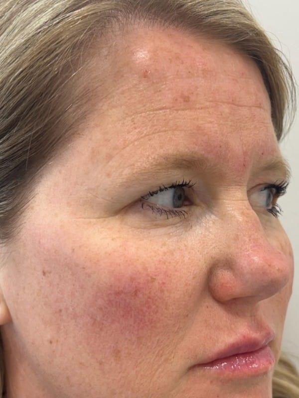 Juvederm after at Healthylooks Med Spa & Wellness in Lee's Summit, MO