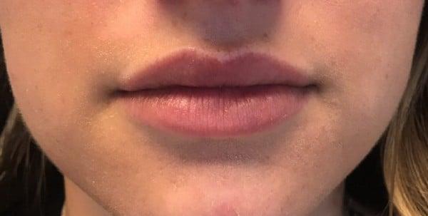 Lip Filler after at Healthylooks Med Spa & Wellness in Lee's Summit, MO