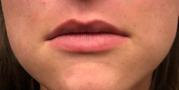 Lip Filler before at Healthylooks Med Spa & Wellness in Lee's Summit, MO