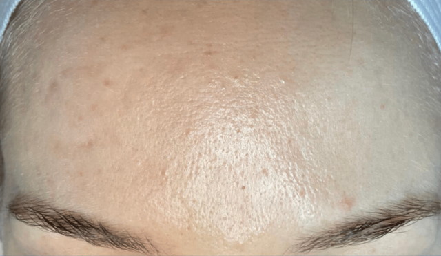 Chemical Peel after at Healthylooks Med Spa & Wellness in Lee's Summit, MO
