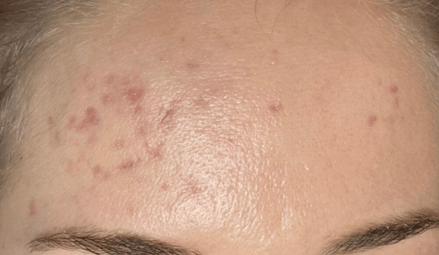 Chemical Peel before at Healthylooks Med Spa & Wellness in Lee's Summit, MO