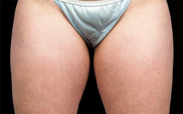 CoolSculpting after at Healthylooks Med Spa & Wellness in Lee's Summit, MO