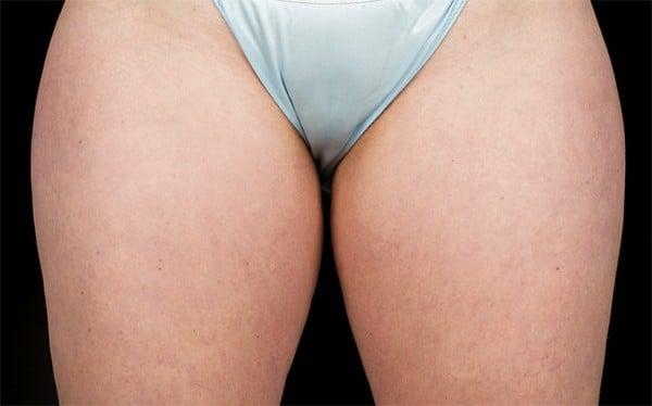 CoolSculpting before at Healthylooks Med Spa & Wellness in Lee's Summit, MO