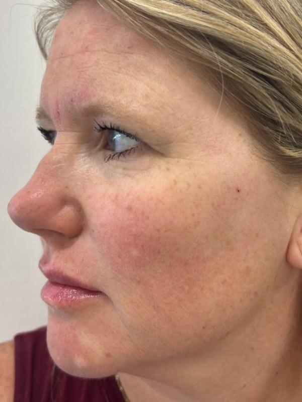 Healthylooks Med Spa & Wellness cheek filler after — Lee's Summit, MO