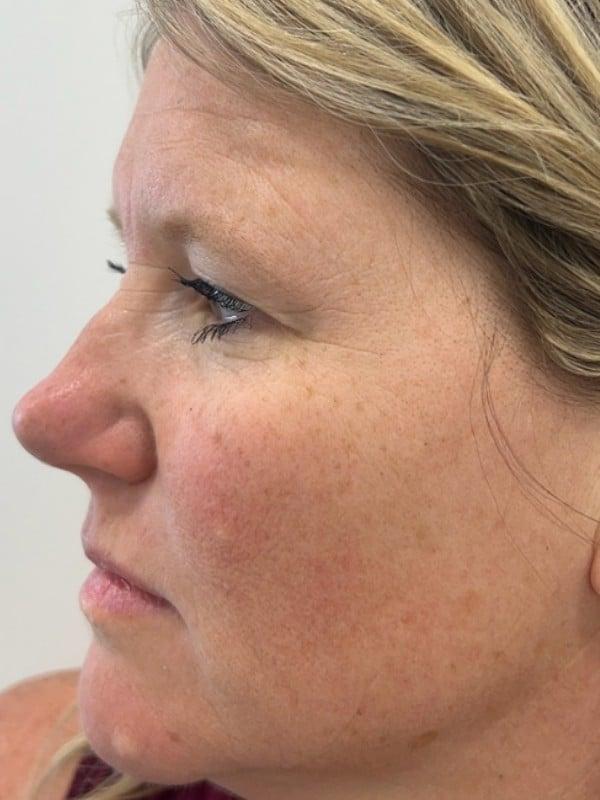 Juvederm before at Healthylooks Med Spa & Wellness in Lee's Summit, MO