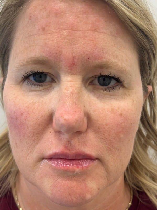 Healthylooks Med Spa & Wellness cheek filler after — Lee's Summit, MO