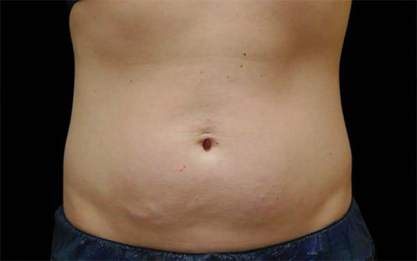 CoolSculpting after at Healthylooks Med Spa & Wellness in Lee's Summit, MO