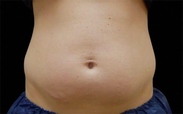 CoolSculpting before at Healthylooks Med Spa & Wellness in Lee's Summit, MO
