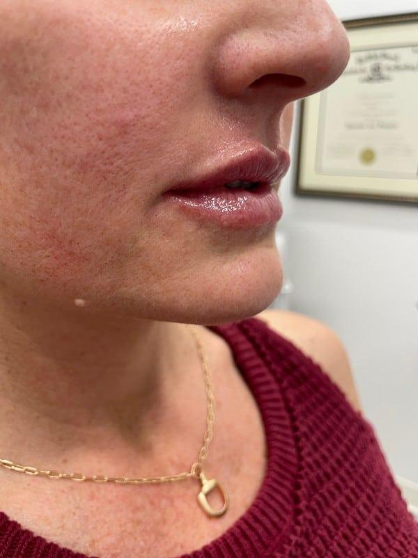 Healthylooks Med Spa & Wellness lip filler after — Lee's Summit, MO