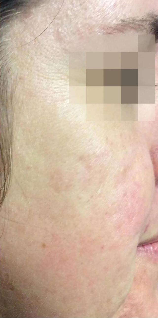 Chemical Peel after at Healthylooks Med Spa & Wellness in Lee's Summit, MO
