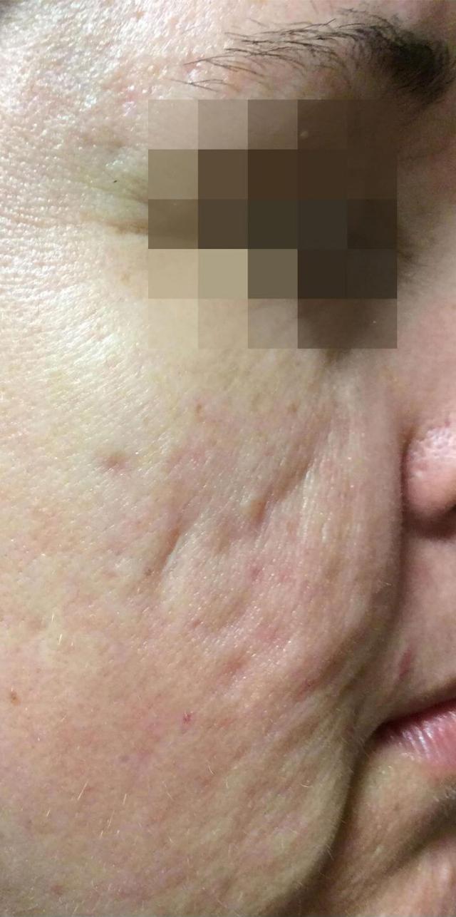 Chemical Peel before at Healthylooks Med Spa & Wellness in Lee's Summit, MO