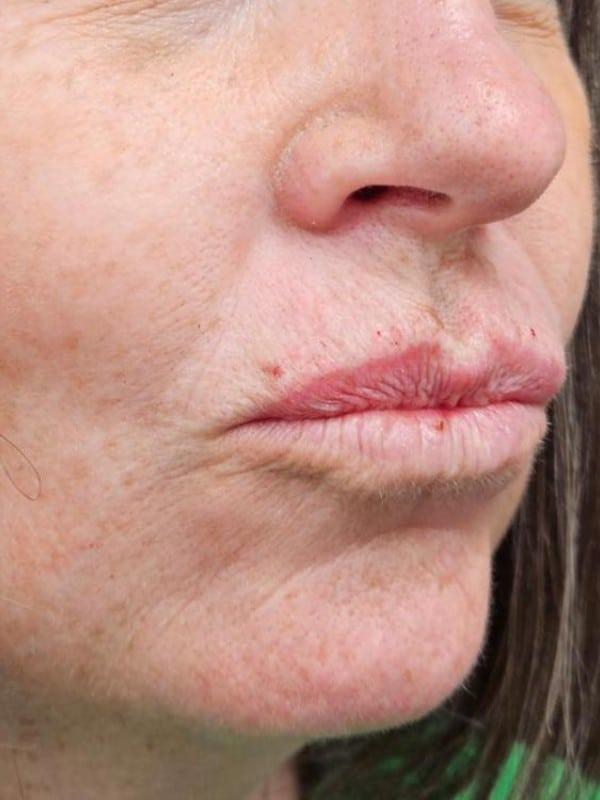 Lip Filler after at Healthylooks Med Spa & Wellness in Lee's Summit, MO
