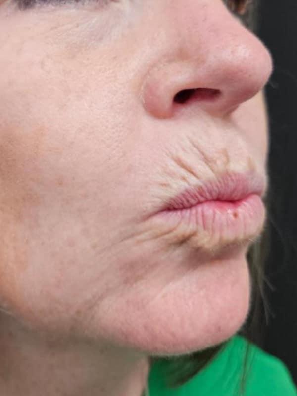 Lip Filler before at Healthylooks Med Spa & Wellness in Lee's Summit, MO