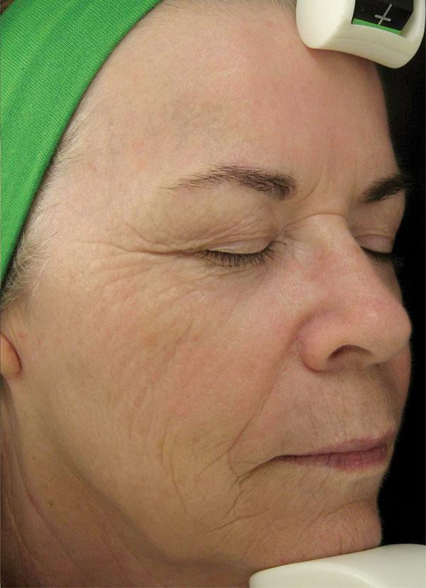 Healthylooks Med Spa & Wellness chemical peel after — Lee's Summit, MO