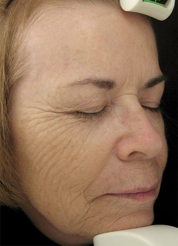 Microneedling before at Healthylooks Med Spa & Wellness in Lee's Summit, MO