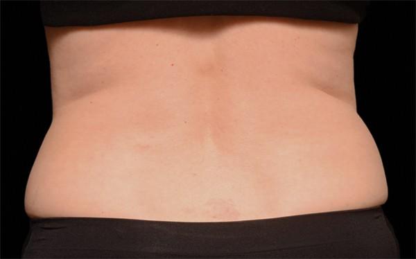 CoolSculpting after at Healthylooks Med Spa & Wellness in Lee's Summit, MO
