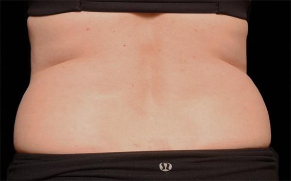 CoolSculpting before at Healthylooks Med Spa & Wellness in Lee's Summit, MO