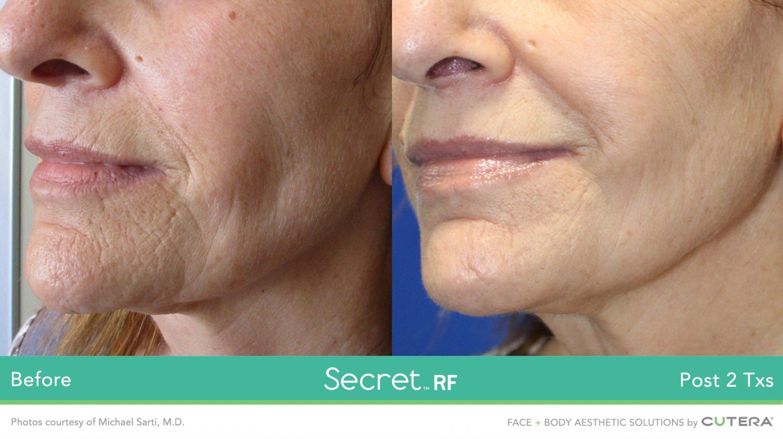 Healthylooks Med Spa & Wellness result — Lee's Summit, MO