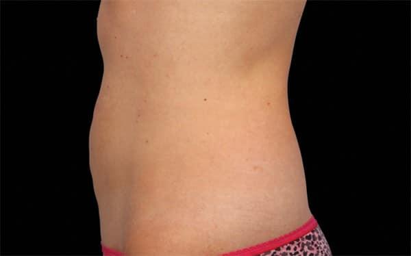 CoolSculpting after at Healthylooks Med Spa & Wellness in Lee's Summit, MO