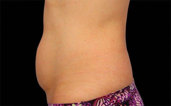 CoolSculpting before at Healthylooks Med Spa & Wellness in Lee's Summit, MO