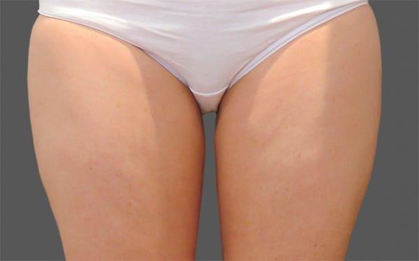 CoolSculpting after at Healthylooks Med Spa & Wellness in Lee's Summit, MO