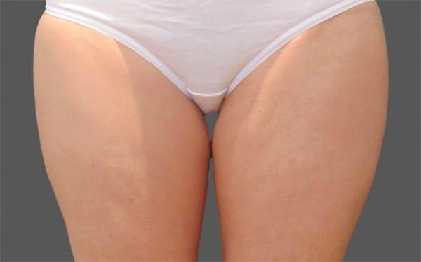 CoolSculpting before at Healthylooks Med Spa & Wellness in Lee's Summit, MO