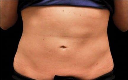CoolSculpting after at Healthylooks Med Spa & Wellness in Lee's Summit, MO