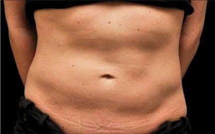 CoolSculpting before at Healthylooks Med Spa & Wellness in Lee's Summit, MO