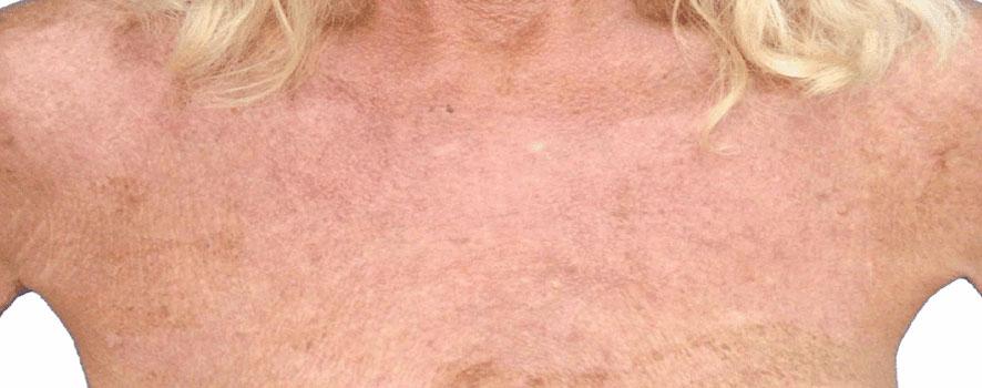 Healthylooks Med Spa & Wellness bbl after — Lee's Summit, MO