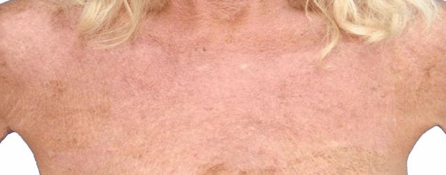 Liquid BBL after at Healthylooks Med Spa & Wellness in Lee's Summit, MO
