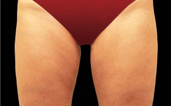 CoolSculpting after at Healthylooks Med Spa & Wellness in Lee's Summit, MO