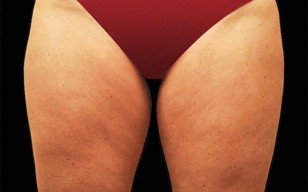 CoolSculpting before at Healthylooks Med Spa & Wellness in Lee's Summit, MO