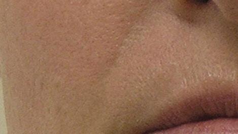 Dermal Fillers after at Healthylooks Med Spa & Wellness in Lee's Summit, MO
