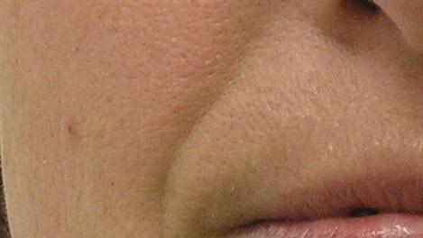 Dermal Fillers before at Healthylooks Med Spa & Wellness in Lee's Summit, MO