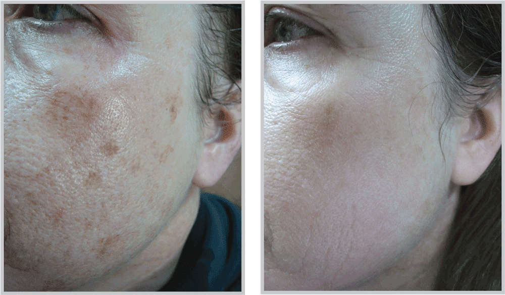 Healthylooks Med Spa & Wellness bbl result — Lee's Summit, MO