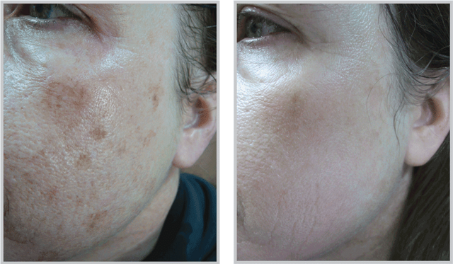 Liquid BBL result at Healthylooks Med Spa & Wellness in Lee's Summit, MO