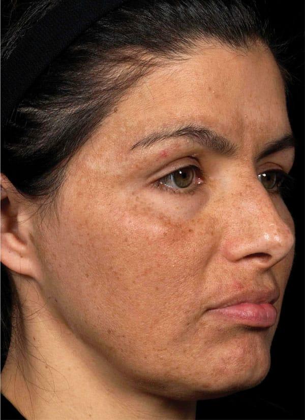 Chemical Peel after at Healthylooks Med Spa & Wellness in Lee's Summit, MO