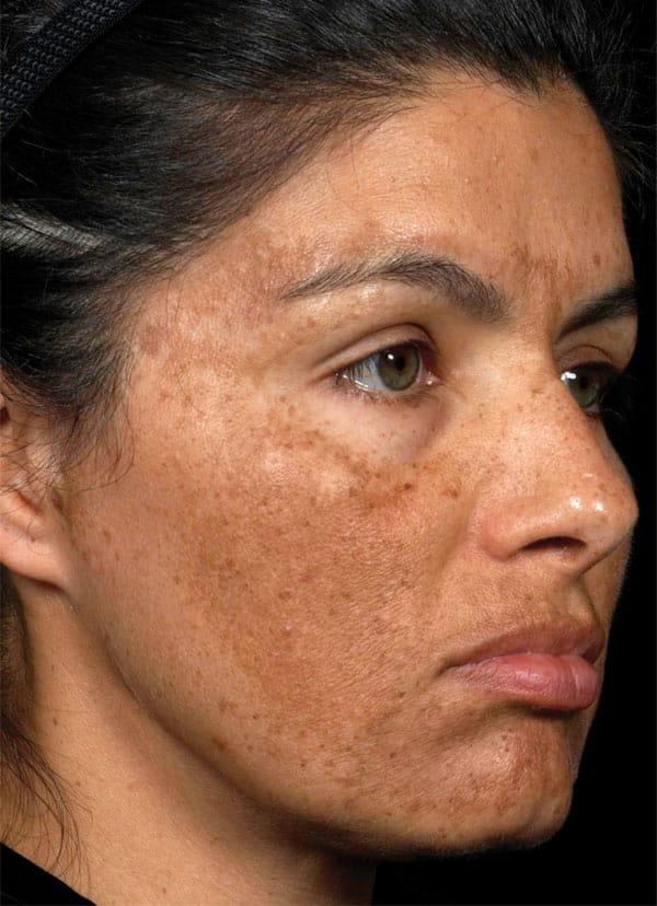 Chemical Peel before at Healthylooks Med Spa & Wellness in Lee's Summit, MO