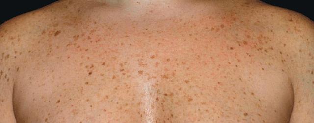 Liquid BBL before at Healthylooks Med Spa & Wellness in Lee's Summit, MO