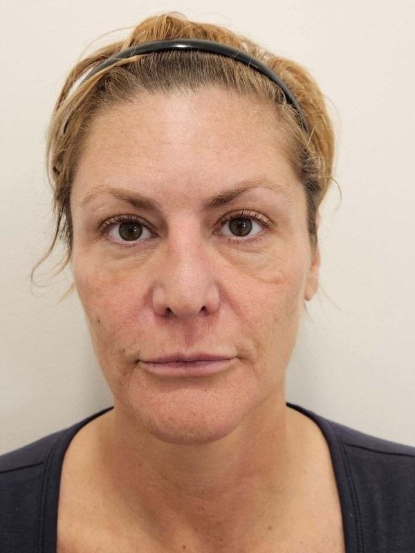 Healthylooks Med Spa & Wellness cheek filler after — Lee's Summit, MO