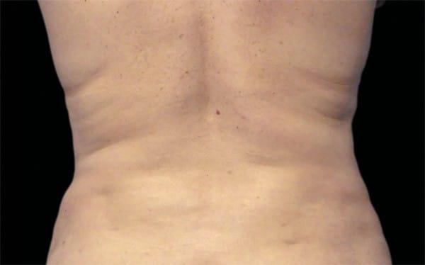 CoolSculpting after at Healthylooks Med Spa & Wellness in Lee's Summit, MO
