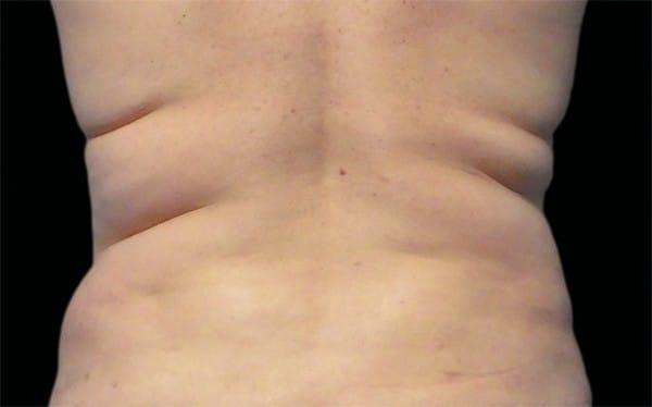 CoolSculpting before at Healthylooks Med Spa & Wellness in Lee's Summit, MO