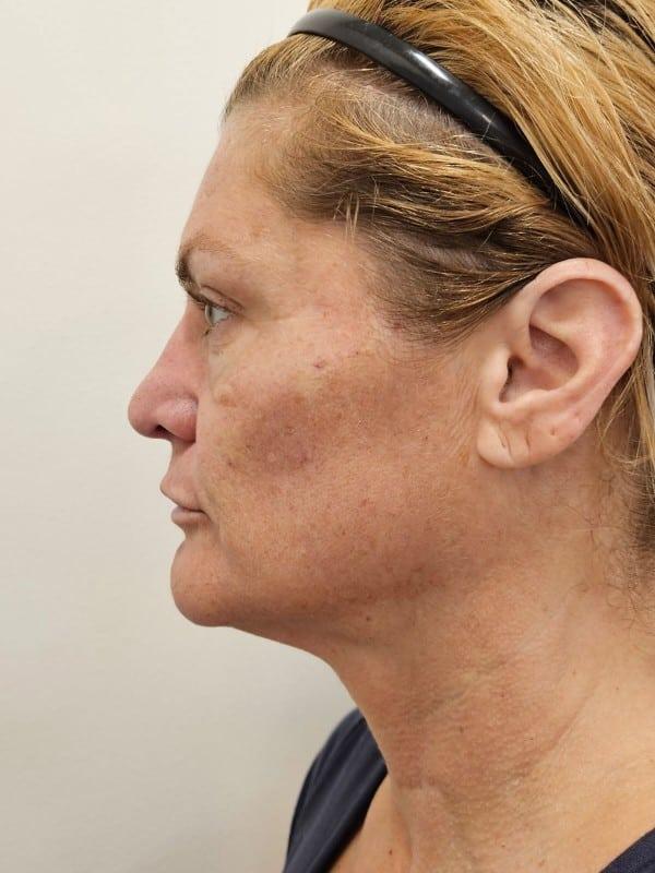 Juvederm after at Healthylooks Med Spa & Wellness in Lee's Summit, MO