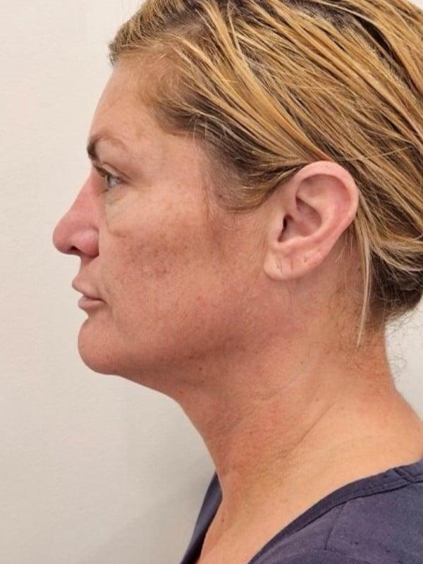 Juvederm before at Healthylooks Med Spa & Wellness in Lee's Summit, MO