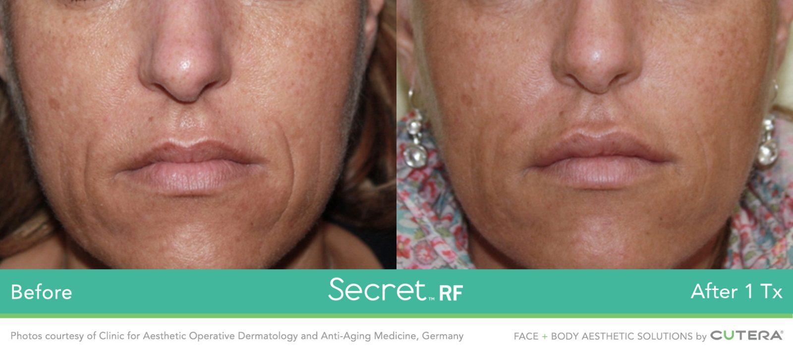 Healthylooks Med Spa & Wellness result — Lee's Summit, MO