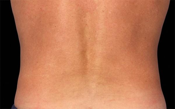 CoolSculpting after at Healthylooks Med Spa & Wellness in Lee's Summit, MO