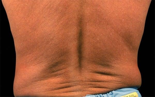 CoolSculpting before at Healthylooks Med Spa & Wellness in Lee's Summit, MO