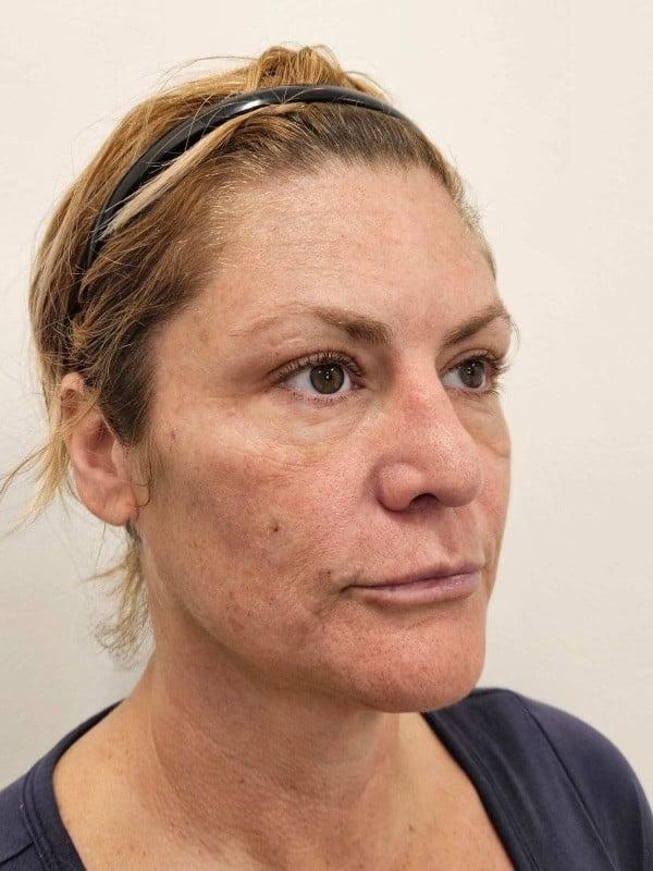 Healthylooks Med Spa & Wellness cheek filler after — Lee's Summit, MO