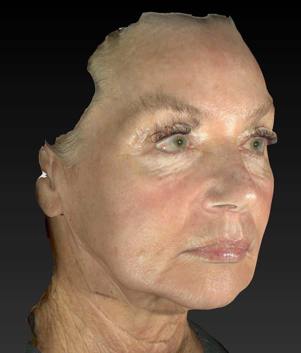 Healthylooks Med Spa & Wellness chemical peel after — Lee's Summit, MO