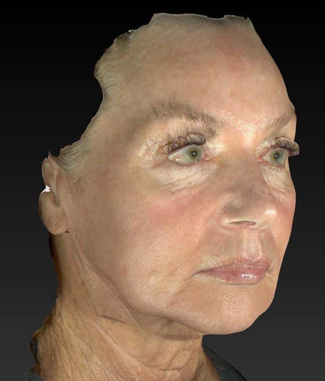 Microneedling after at Healthylooks Med Spa & Wellness in Lee's Summit, MO